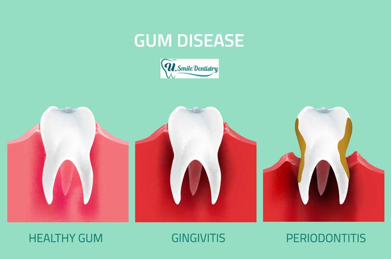 gum disease