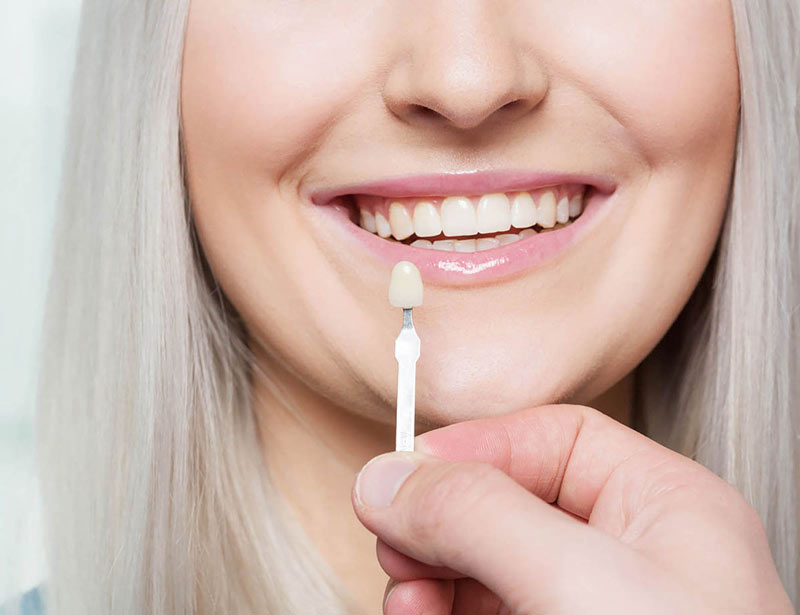 Dental veneers in Orangeville