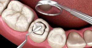 Root canal and Dental Crowns