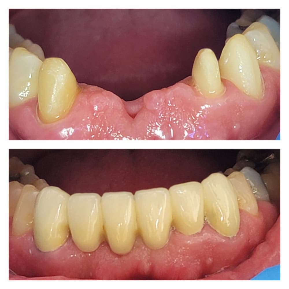 Dental treatment gallery case at U Smile Dentistry