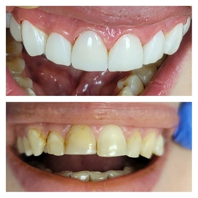 Dental treatment gallery case at U Smile Dentistry