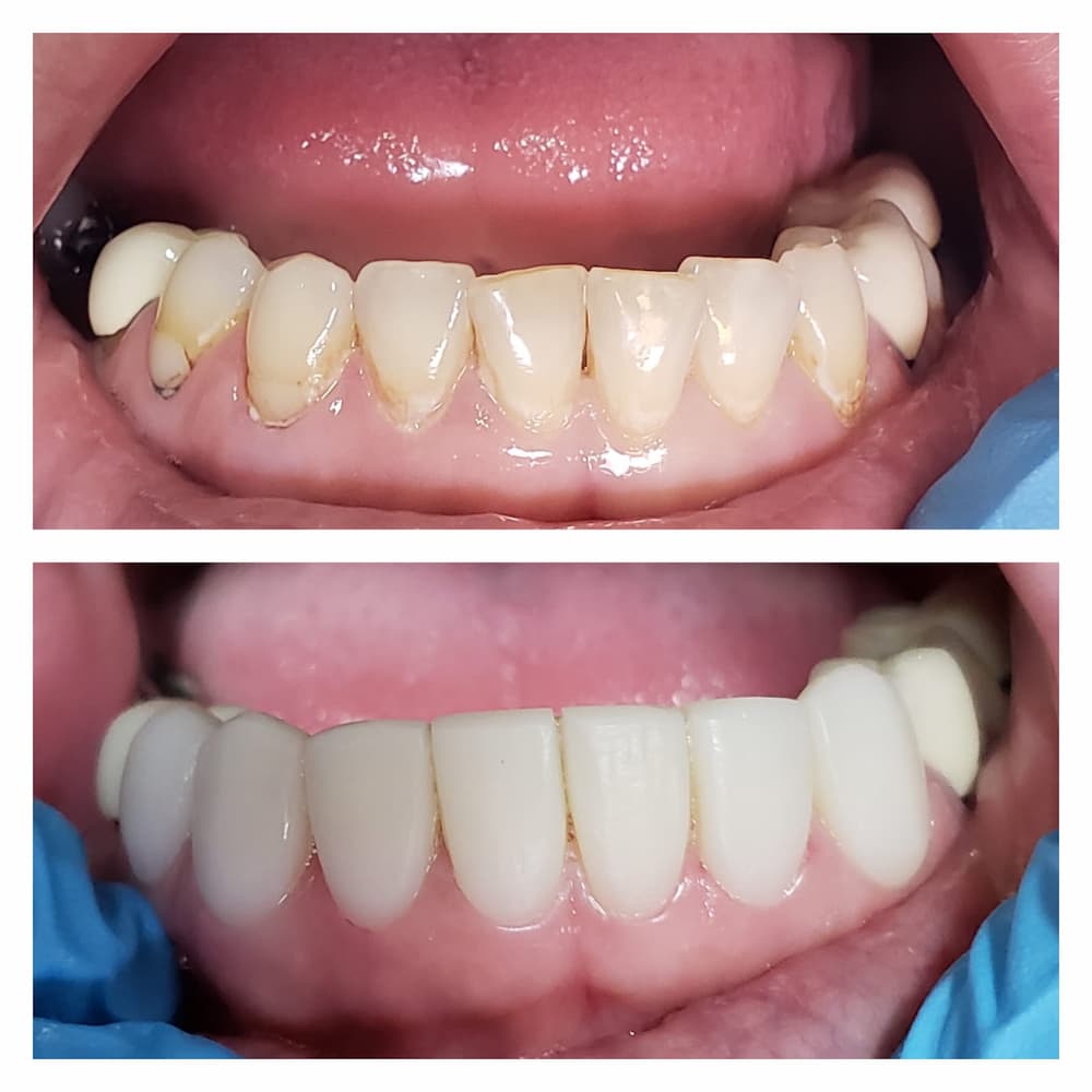 Dental treatment gallery case at U Smile Dentistry