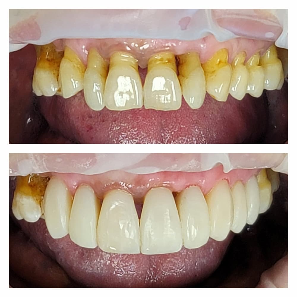 Dental treatment gallery case at U Smile Dentistry