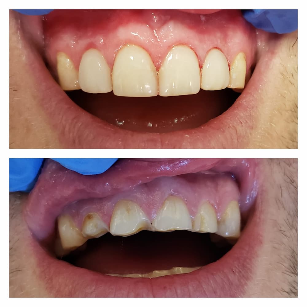 Dental treatment gallery case at U Smile Dentistry
